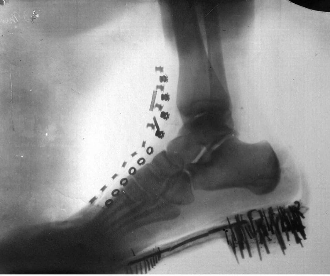 Tesla captured an X-ray image of his own foot